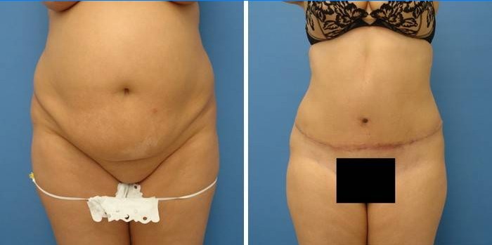 Foto prima e dopo l'addominoplastica dell'addome