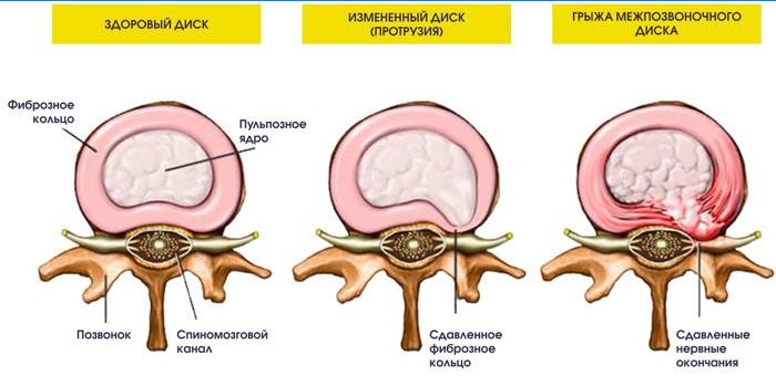 Sporgenza ed ernia del disco intervertebrale