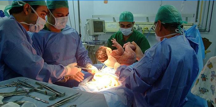 Equipe medica che esegue un taglio cesareo