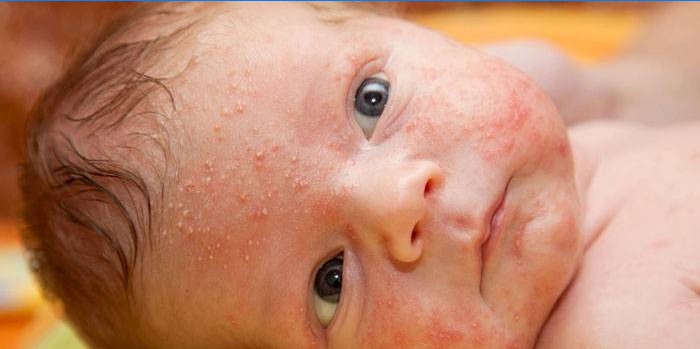 Eruzione cutanea ormonale in un bambino sul viso
