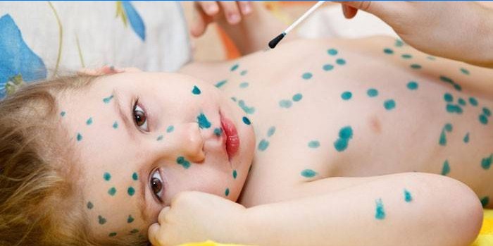 Il bambino ha la varicella
