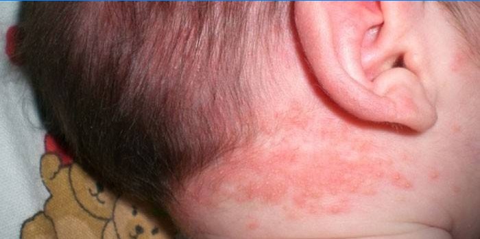 Un'eruzione cutanea sul collo del bambino