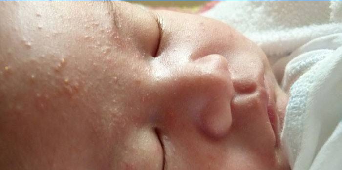 Manifestazioni di un'eruzione neonatale sul viso di un bambino