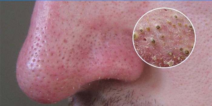 pimple-on-neck-causes-and-how-to-treat-them-healthnews