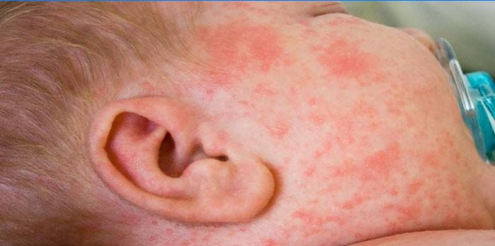 Eruzione allergica sul viso del bambino