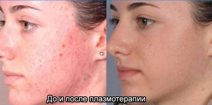 Pelle del viso prima e dopo la terapia al plasma
